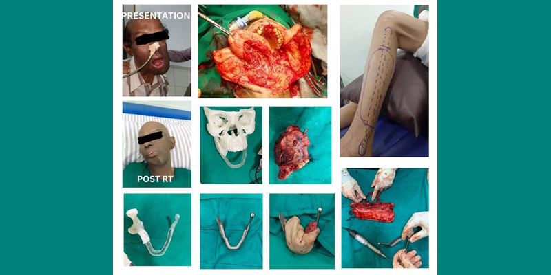 Ameloblactic carcinoma a rare mandible malignancy.