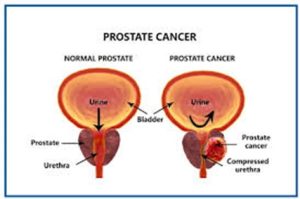 Prostate cancer