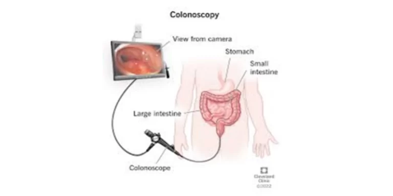 colonoscopy Hashamitra