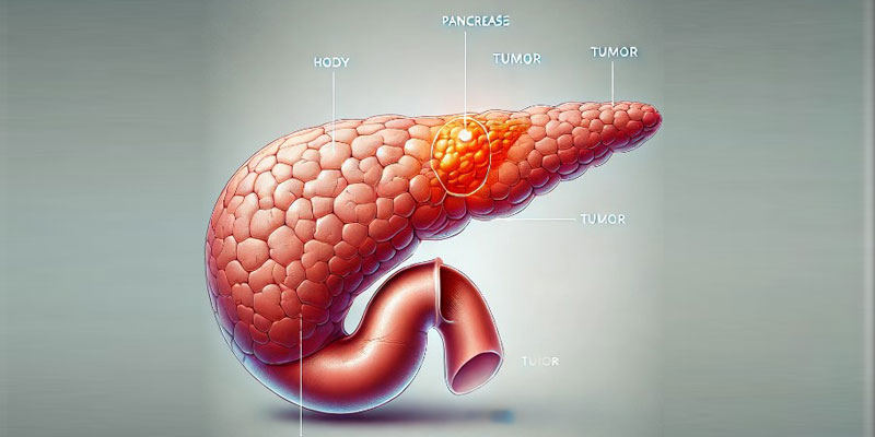 Overview of Pancreatic Cancer in India