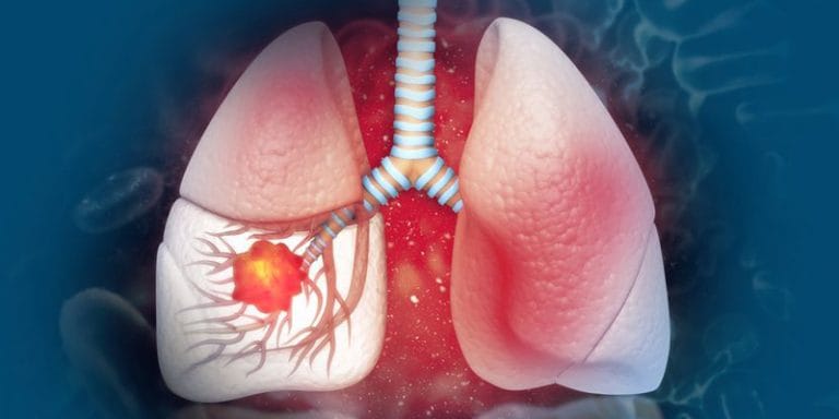 lung-cancer-blog