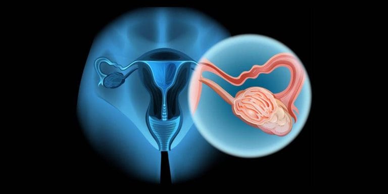 ovarian-cancer-treatment