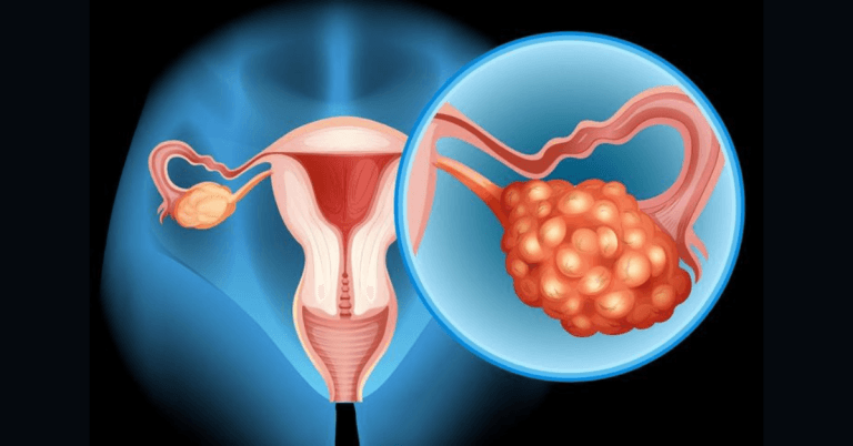 Can PCOS cause ovarian cancer