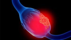 ovarian cancer specialist